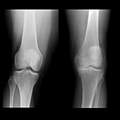 Composite X-rays of Knees