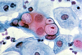 LM of cervical smear showing Chlamydia in