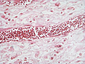 Capillaries in a Matrix of Liver Cancer C