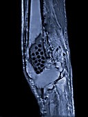 Osteomyelitis,Knee MRI