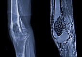 Osteomyelitis,Knee X-Ray/MRI