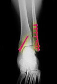 Fractured Ankle With Screws and Plates