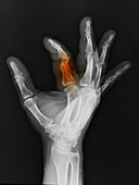 Broken Proximal Phalanx of Index Finger