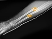 Forearm Fracture in a 16 Year Old Boy