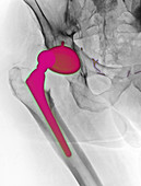 Dislocated Hip Replacement