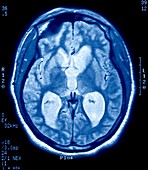 Alzheimer's disease,MRI brain scan