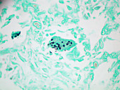 Lung Tissue with Pneumocystosis (LM)