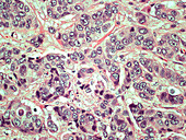 Invasive Ductal Carcinoma,LM