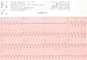 Abnormal EKG