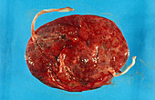 Double Placenta