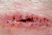 Healing Leg Wound