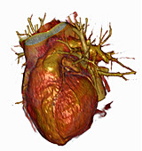 3D CT Scan of Heart