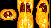 Lung Cancer,CT Scan