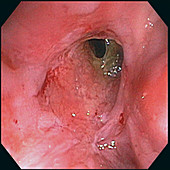 Ileo-Anal Anastomosis