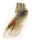 Post Surgery Foot X-ray