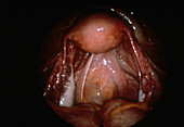 Uterus,Laparoscopic View