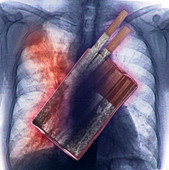 Cigarettes and Lung Cancer