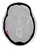 Subdural Hematoma,CT Scan