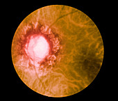 Retina Infected by Syphilis