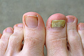 Fungus Infection on Male Toe