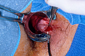 Hemorrhoidectomy: Laser Cutting