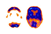 Normal and Alzheimer's Brain Scans