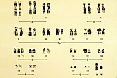 Male Karyotype with Trisomy 18