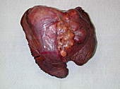Hepatocellular Carcinoma in Liver