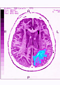 Cerebrovascular Disease