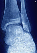 Ankle Dislocation