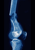 Femoral Fracture