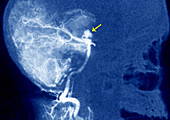 Hereditary hemorrhagic telangiectasia