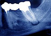 Dental Abscess X-ray