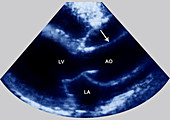 Dissecting Aneurysm of Aorta