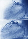 Myocardial Infarction