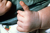 Hand with Birth Defect