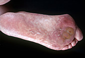 Syphilis,Secondary Stage