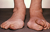Dislocated Toes,Tabes Dorsalis