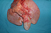 Mucocele of Gallbladder