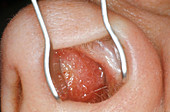 Nasal Septum,Angioma