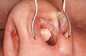 Papilloma,Nasal Septum