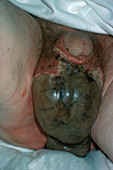 Gangrene of Testicles