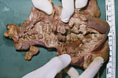 Caecum with Cancer and Polyps