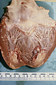Secondary Heart Cancer