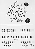 Male Karyotype & Metaphase Chromosomes