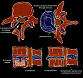 Illustration of Spinal Disk Pathologies