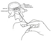 Illustration of Lumbar Puncture