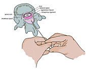 Illustration of Lumbar Puncture