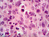 LM of Squamous Cell Carcinoma