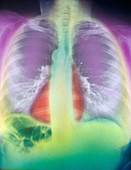 Chest X-ray